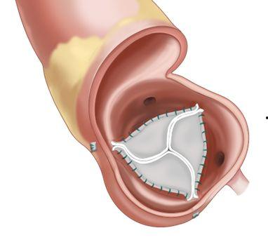 国产疝气补片发展史视频,国产疝气补片发展历程回顾